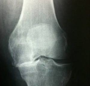 Arthrose